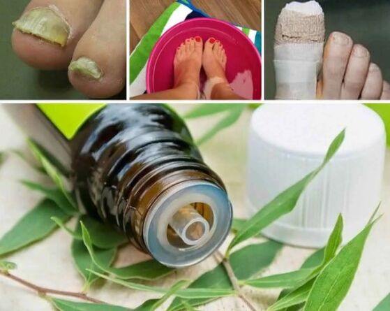 Hongo de Tea Tree For Nails