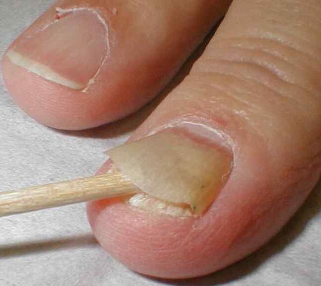 descamación de la uña con hongos en las uñas de los pies