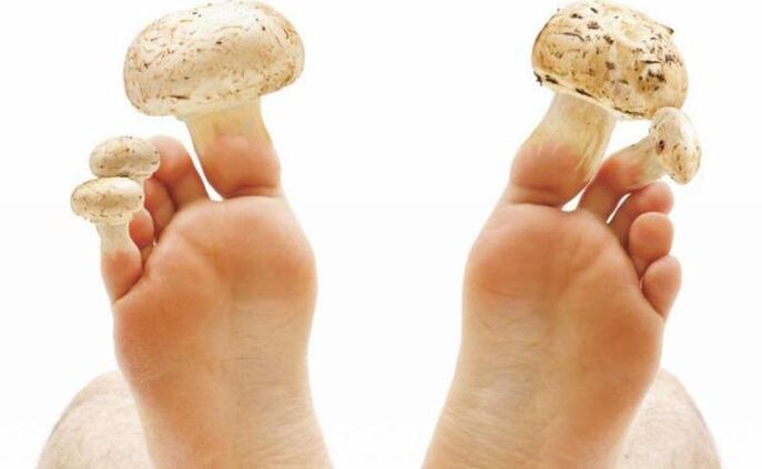 causas, síntomas y tratamiento de hongos en los pies