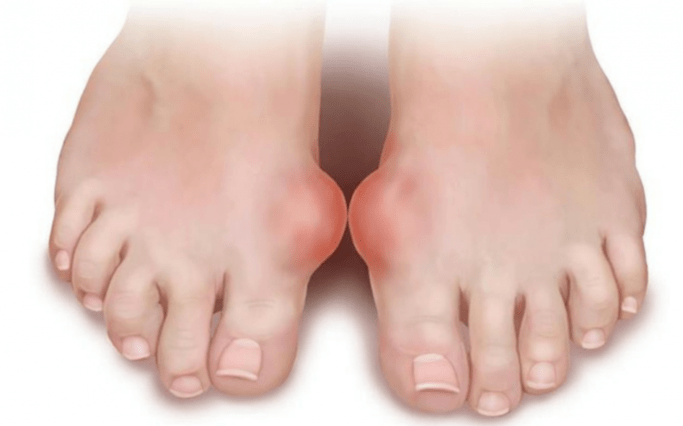 deformidad del pie como causa de la aparición de hongos en las piernas