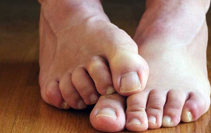 síntomas de hongos escamosos en los pies