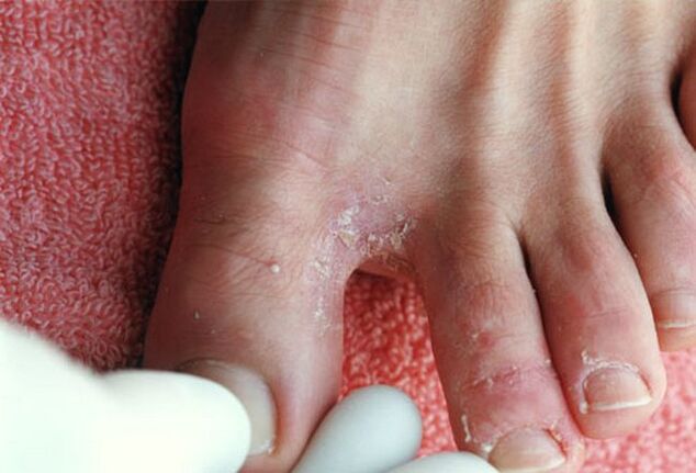 síntomas de hongos entre los dedos de los pies