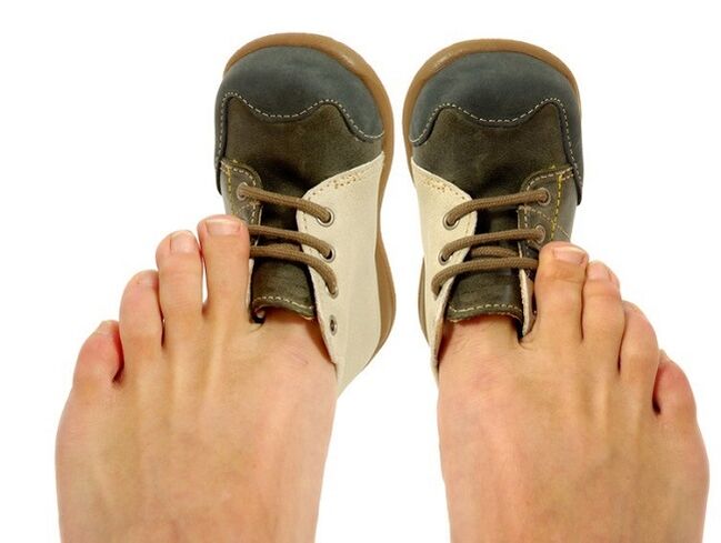 zapatos apretados como causa de hongos entre los dedos de los pies