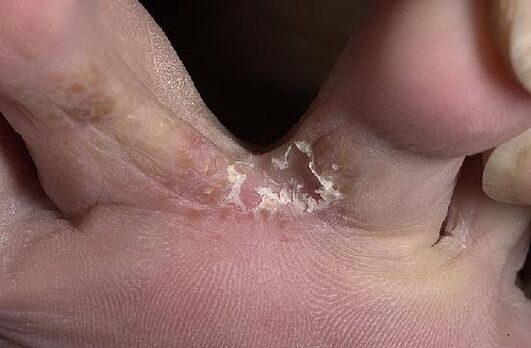 dedos de los pies afectados por hongos