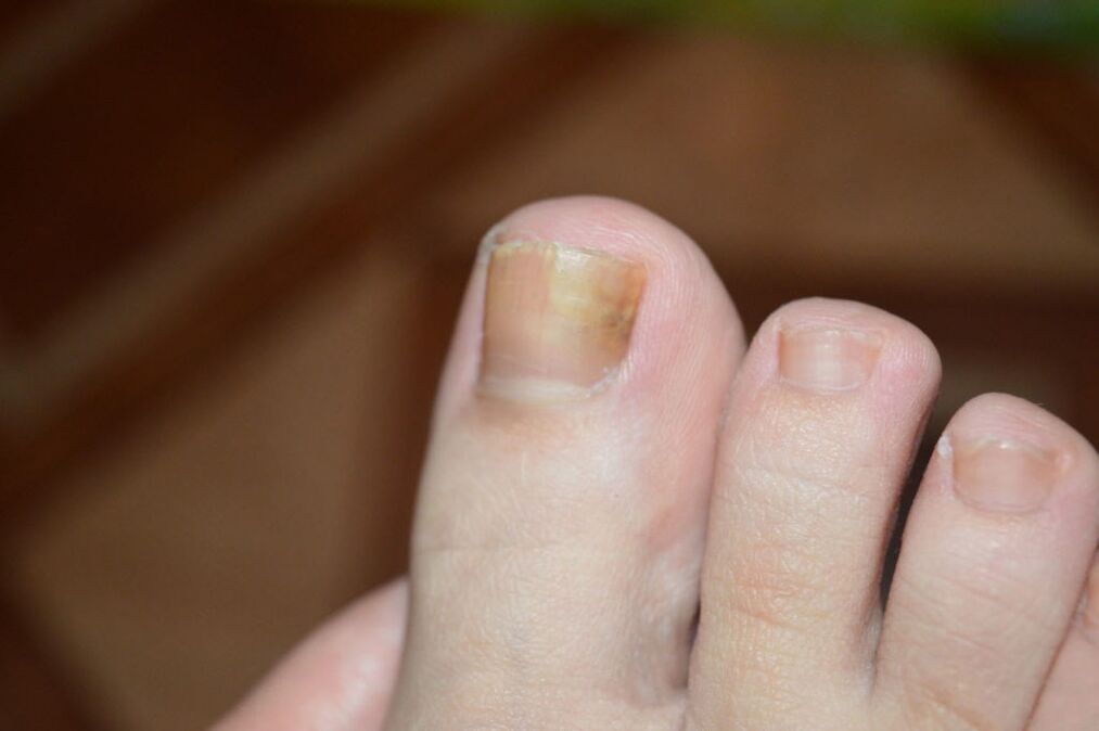 La etapa inicial de los hongos en las uñas de los pies. 