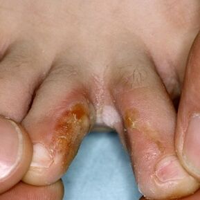 Signos de hongos entre los dedos de los pies. 