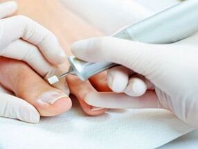 Pedicura terapéutica para hongos en las uñas de los pies. 