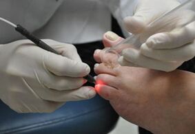 Tratamiento con láser para hongos en las uñas de los pies. 