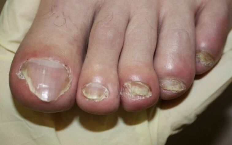 Hongo de uñas