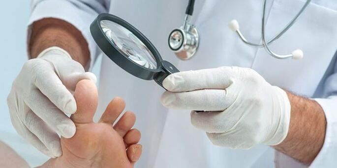 El médico examinó el pie infectado con un hongo