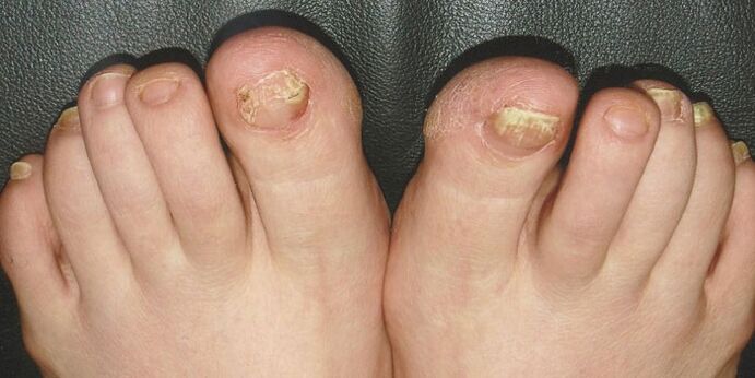 Onicomicosis de las uñas en las piernas