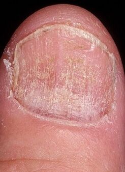 Micosis de la uña