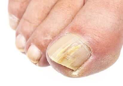 ¿Cómo se ve el hongo de uñas