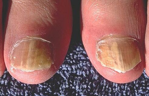 Uñas afectadas por dermatofitas