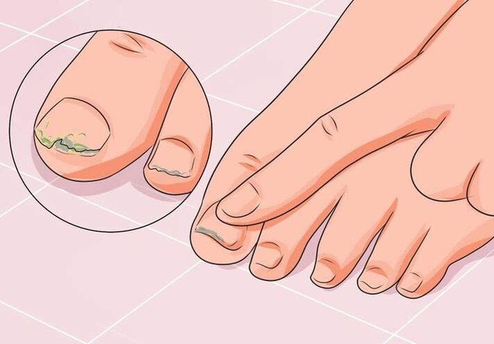 Cómo tratar los hongos en las uñas de los pies con gotas.