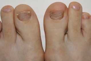 Los síntomas de la aparición de hongos en los pies